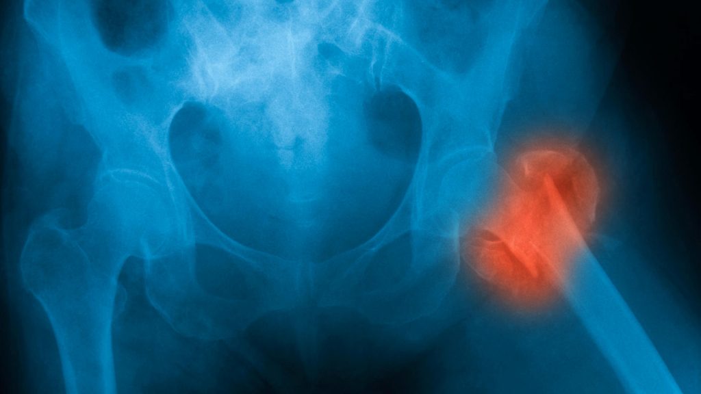 Osteoporose: Grund für Knochenbrüche im Alter