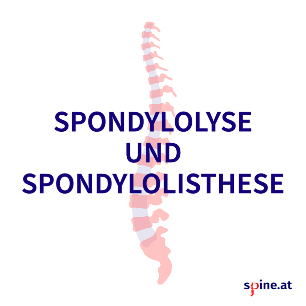 Alles zum Thema “Spondylolyse und Spondylolisthese”